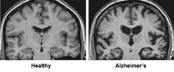egészséges és Alzheimer kóros agy